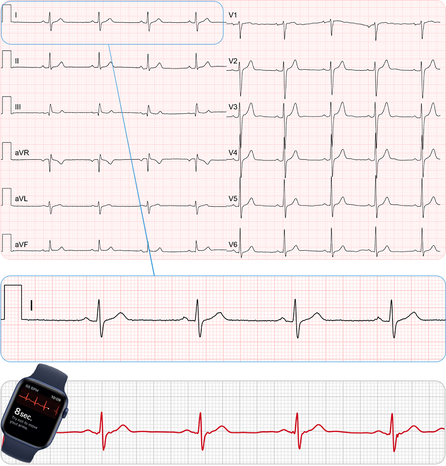 Svod I: 12 svodové EKG vs EKG hodinky