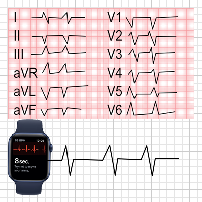 Standardní dvanáctisvodové EKG EKG a EKG z Apple hodinie.