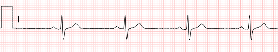 standardní ekg: svod I