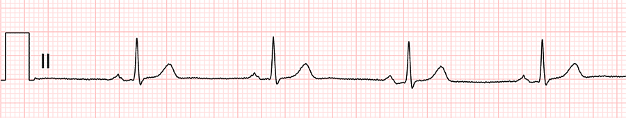 standardní ekg: svod II