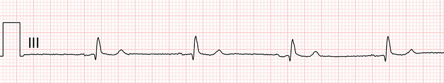 standardní ekg: svod III