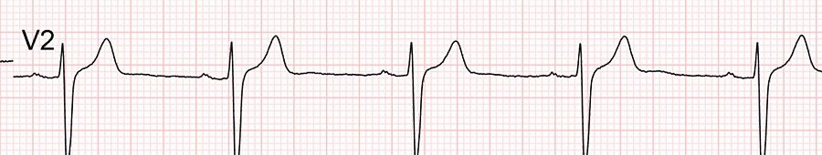 standardní ekg: svod V2