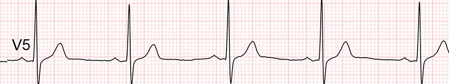 standardní ekg: svod V5