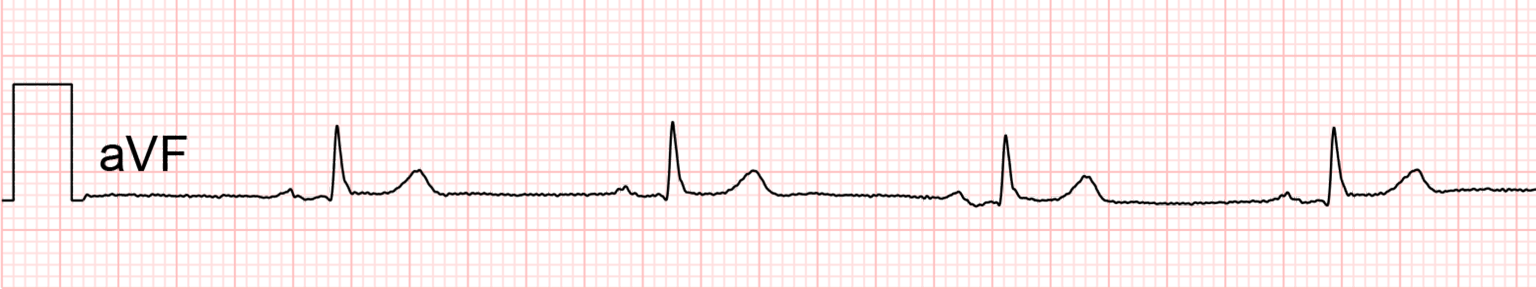 standardní ekg: svod aVF