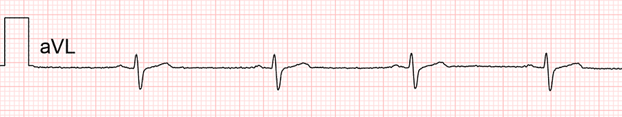 standardní ekg: svod aVL