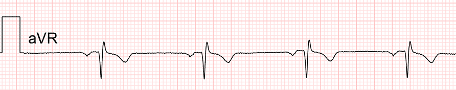 standardní ekg: svod aVR