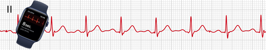 EKG apple hodinky: svod II