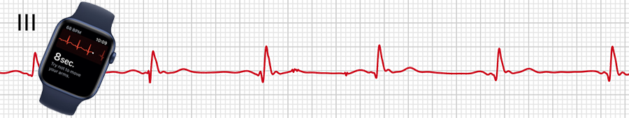 EKG apple hodinky: svod III
