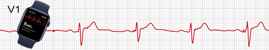 EKG apple hodinky: svod V1