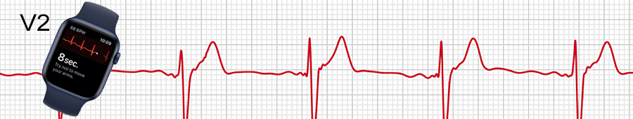 EKG apple hodinky: svod V2