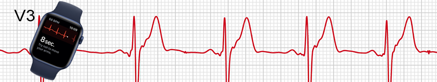 EKG apple hodinky: svod V3