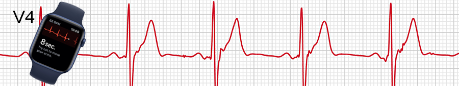 EKG apple hodinky: svod V4