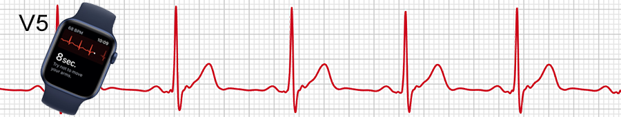 EKG apple hodinky: svod V5