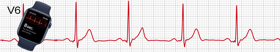 EKG apple hodinky: svod V6
