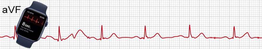 EKG apple hodinky: svod aVF