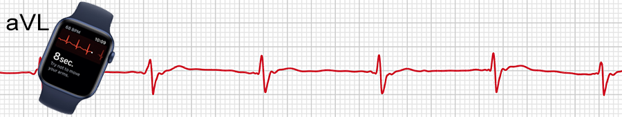 EKG apple hodinky: svod aVL