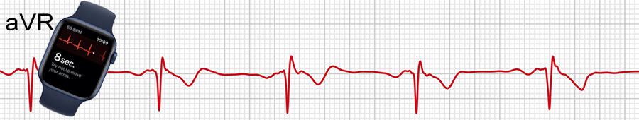 EKG apple hodinky: svod aVR