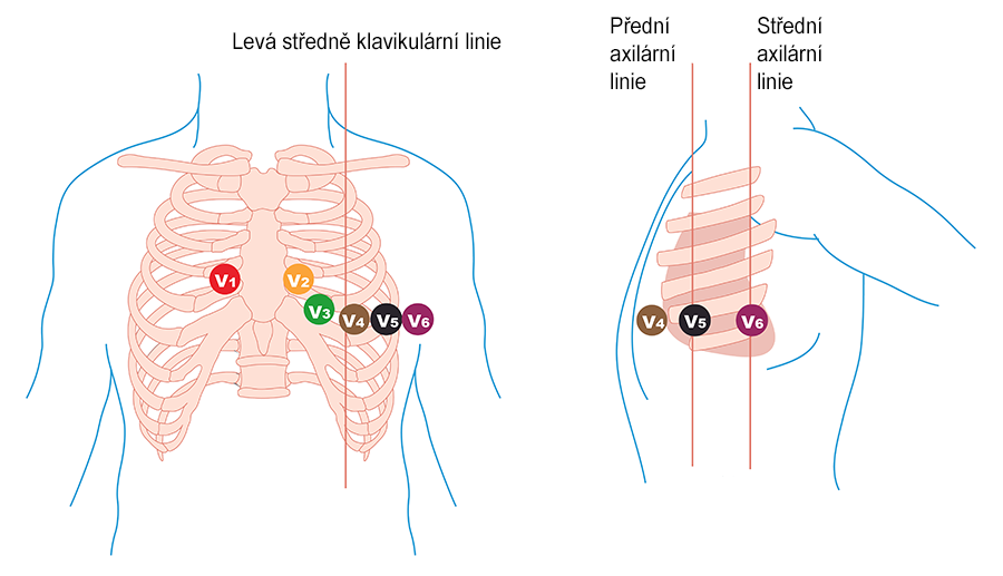 jak naložit hrudní EKG svody