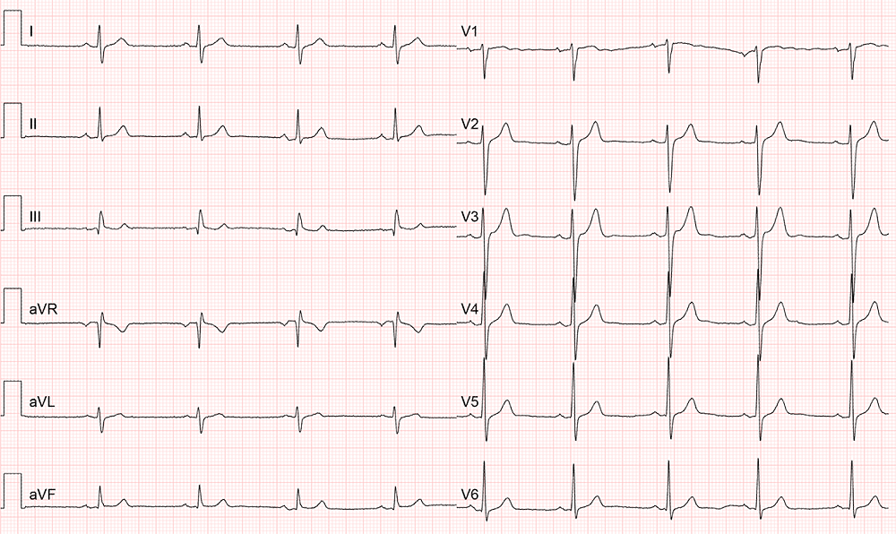 normální 12 svodové EKG