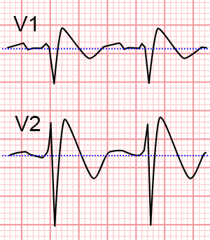 EKG brugada znak V1 a V3