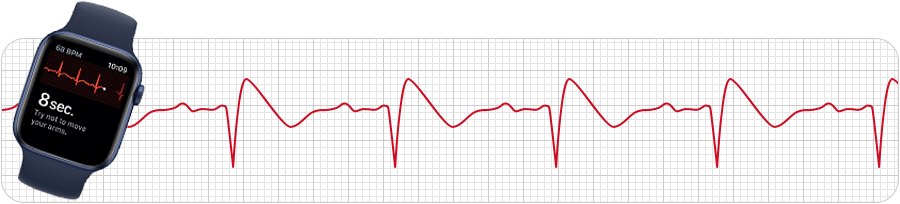 EKG Brugada znak a syndrom. EKG apple hodinky ve 2. mezirebří