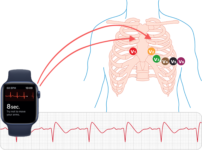 EKG hodinky ve 2. mezirebru, Brugada syndrom